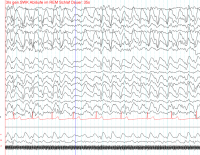 Современные технологии против эпилепсии